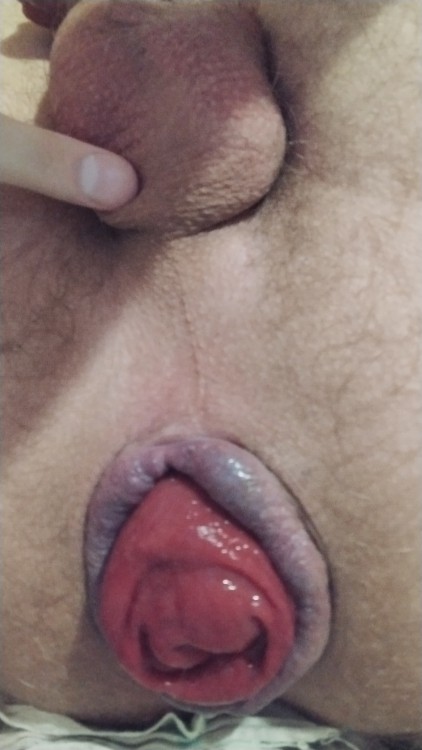 Пролапс prolapse